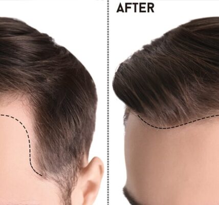 Best Hair Transplant in Islamabad